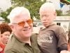 Geneticists believe that albinism may have its roots in sub-Saharian Africa, which may explain why the prevalence of the genetic condition is much higher there. To date, 1 in 2,000 people have albinism in this part of the world, whereas in North America, 1 in every 20,000 have the condition.